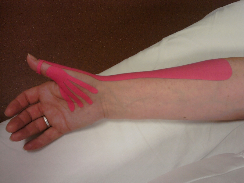 Kineziotaping